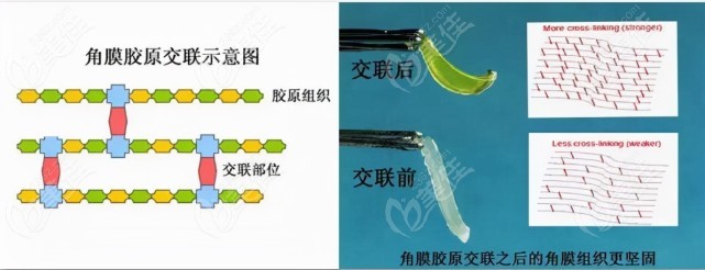 角膜胶原交联手术可以提高视力吗？