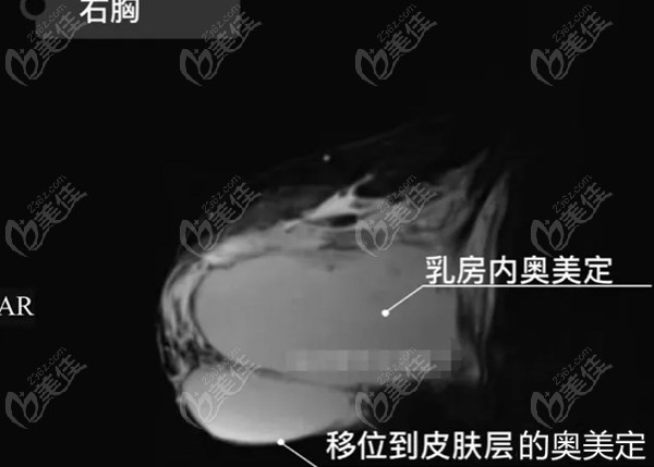 奧美定取出率高嗎www.23/6z.com