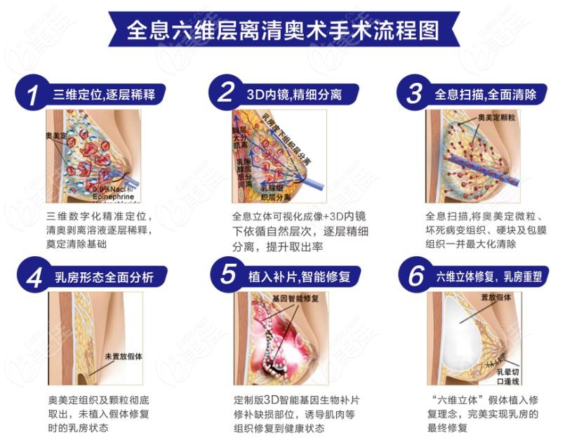 广州荔湾人民医院取出奥美定好