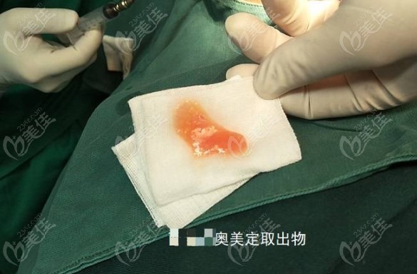 胸部奧美定取出國內(nèi)哪家醫(yī)院好呢