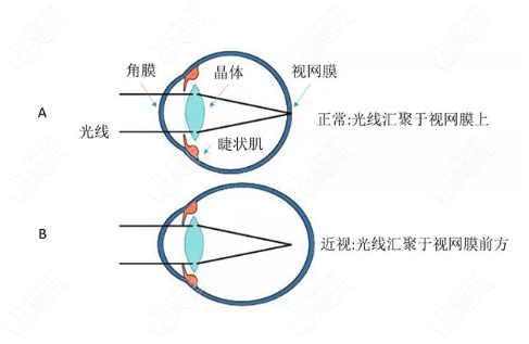 近視的原因