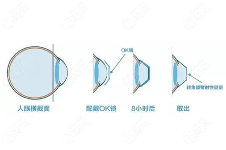 ok鏡的近視控制原理