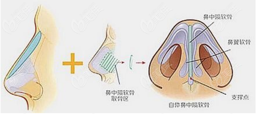 236z.com朱刚强医生隆鼻