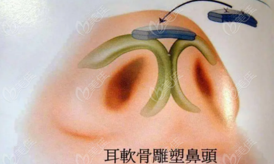 朱刚强医生鼻综合