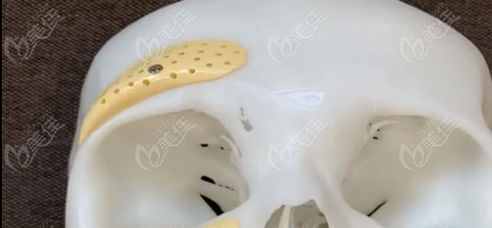 杭州陳小平醫(yī)生眉弓填充不錯