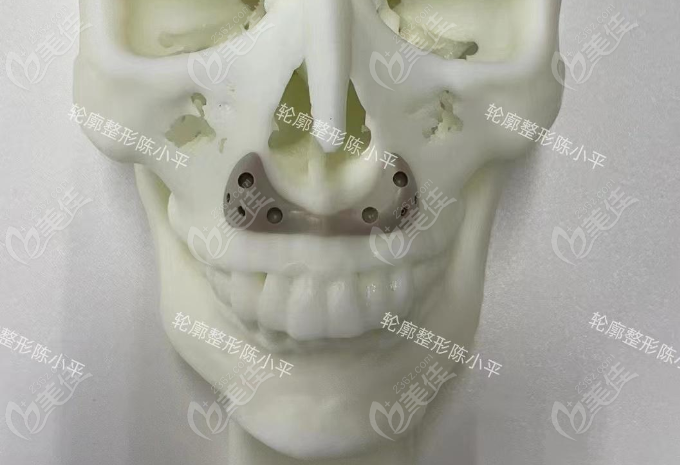 杭州陳小平醫(yī)生鼻基底填充怎么樣？挺好的