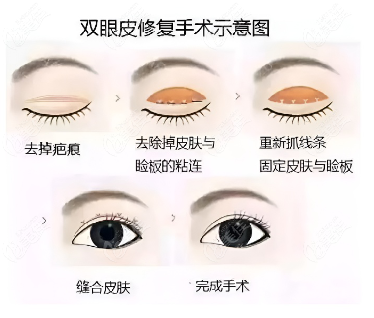 <!--<i data=20240703-sp></i>-->双眼皮修复华美和爱尚丽格哪家好