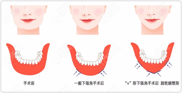 做方脸削骨手术的原理图