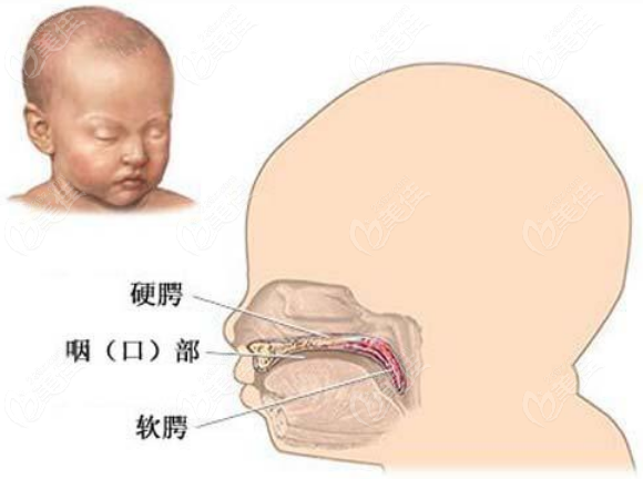 辽宁杏林整形外科唇腭裂免费修复公益