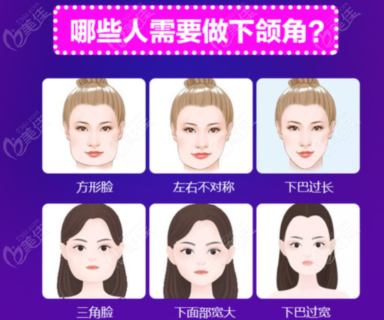 誰(shuí)找過(guò)樸興植做過(guò)下頜角