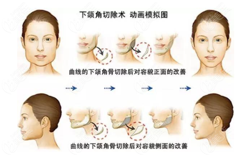 樸興植下頜角手術(shù)怎么樣