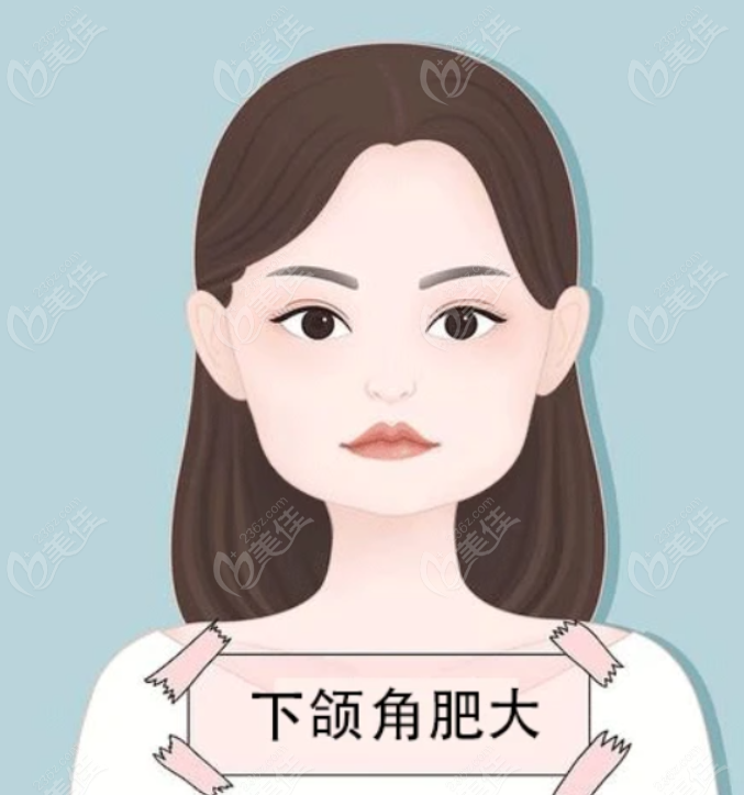 樸興植下頜角手術(shù)多少錢(qián)