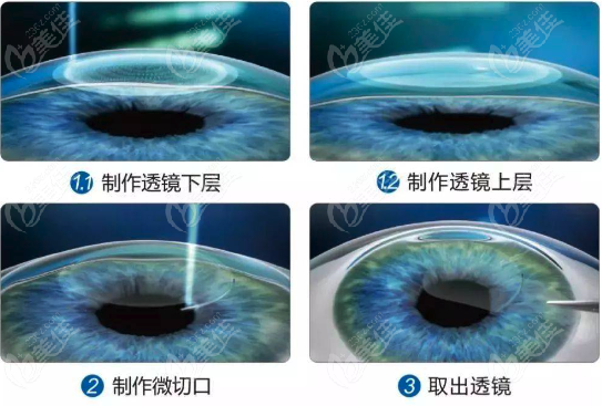 何氏眼科可以操作半飞秒激光近视眼手术