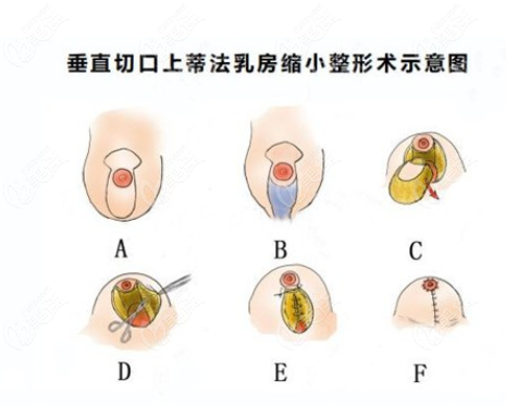 大胸缩小术图片