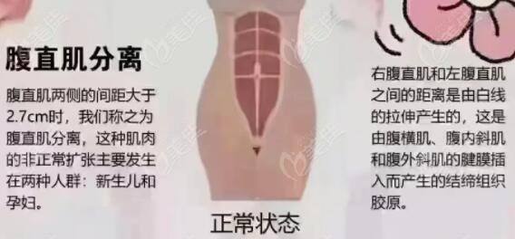 腹直肌分離的原因