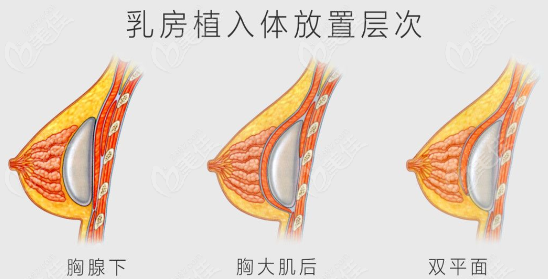 吳毅平醫(yī)生隆胸技術(shù)贊