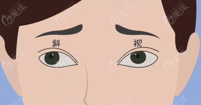 希玛眼科做斜视手术怎么样？