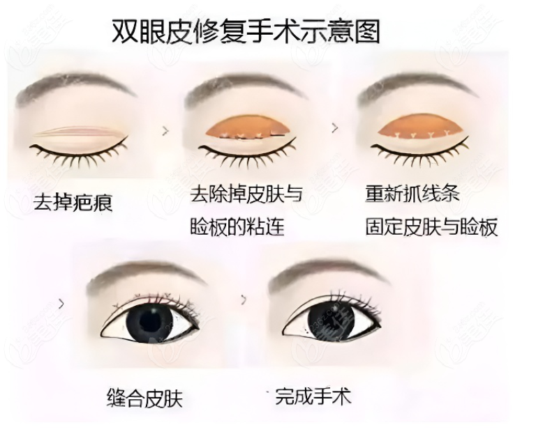 上海伯思立徐曉斐雙眼皮修復怎么預約