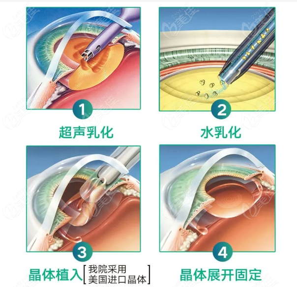 吉林恒達眼科醫院超聲乳化白內障價格