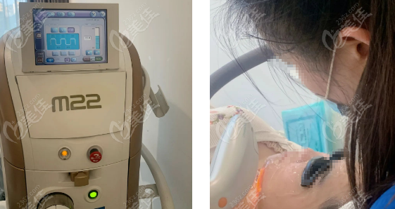 icon光子嫩肤和M22光子嫩肤哪个好