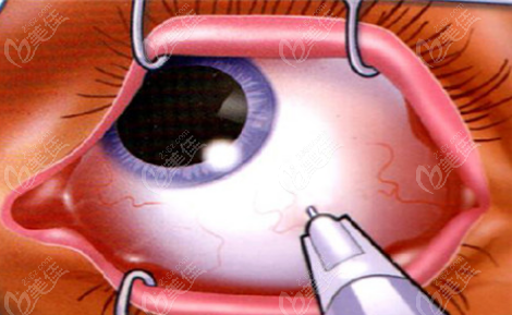 微创玻璃体切除手术能恢复正常视力