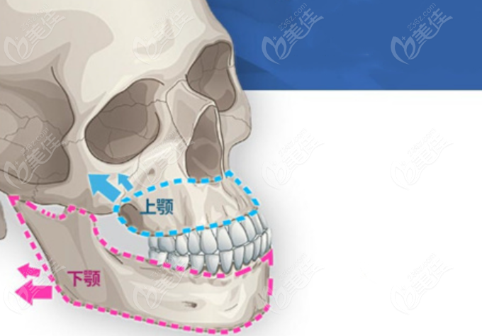 韩国必妩双鄂手术示意图
