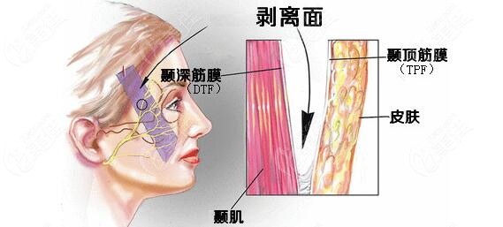 臉部拉皮v美減齡技術信賴