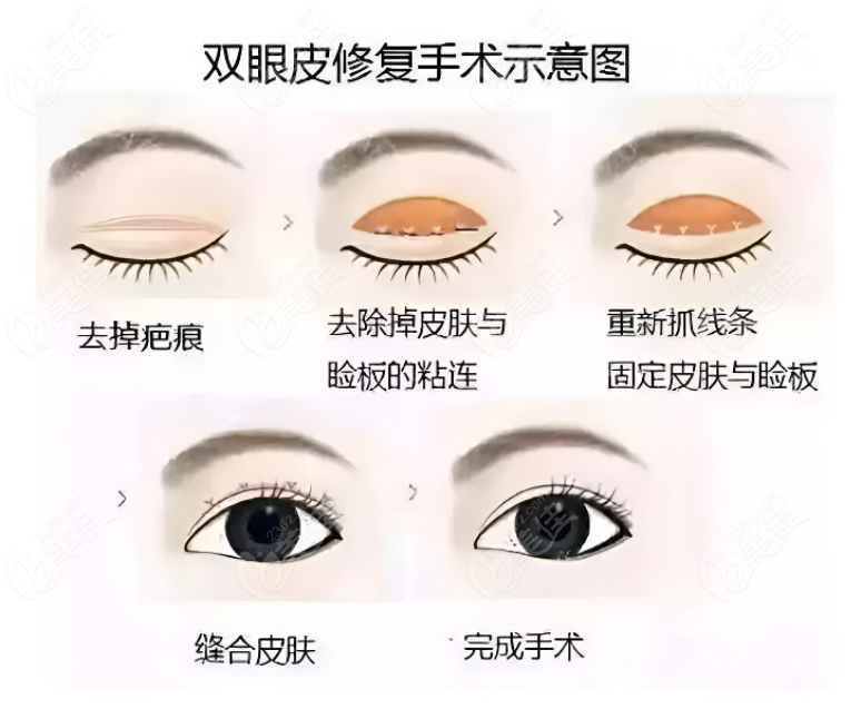上海美莱何祥龙双眼皮修复手术过程和步骤