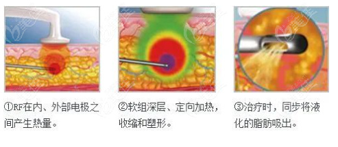 深圳宝丽太黄金微雕多少钱