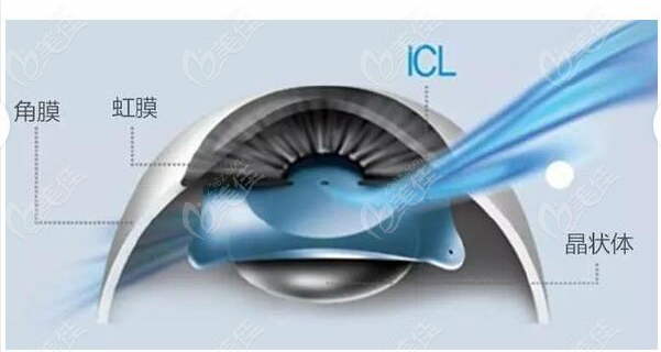 成都中医大银海眼科ICL晶体植入术费用
