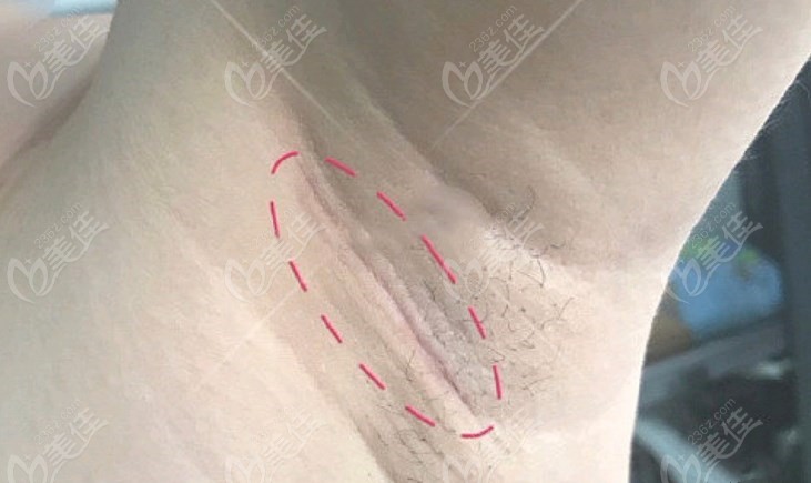 隆胸腋下切口恢复3个月图片www.23/6z.com