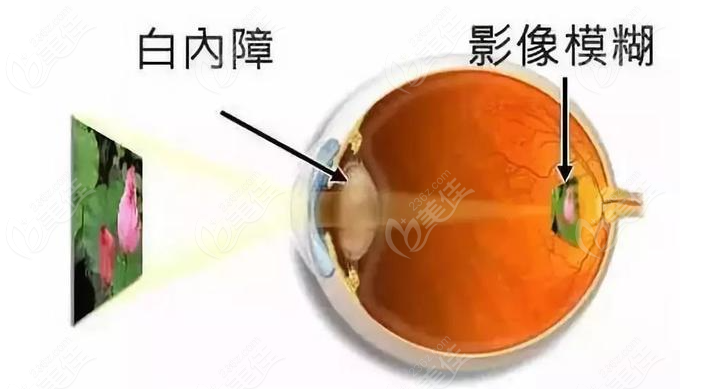万修华看白内障怎么样？