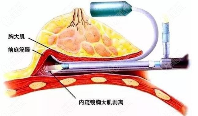 南京友誼整形醫(yī)院做假體隆胸技術(shù)好
