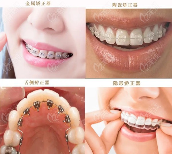 拜爾口腔牙齒矯正收費：8000-50000元左右
