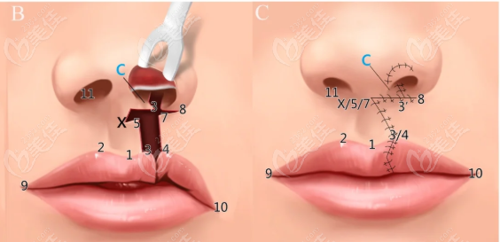 成人唇裂二期修复手术图片