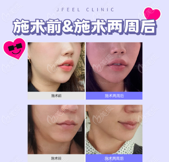 韩国皮肤科jfeel下颌缘提升对比照