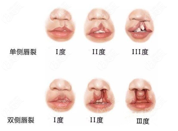 李钢唇裂实例