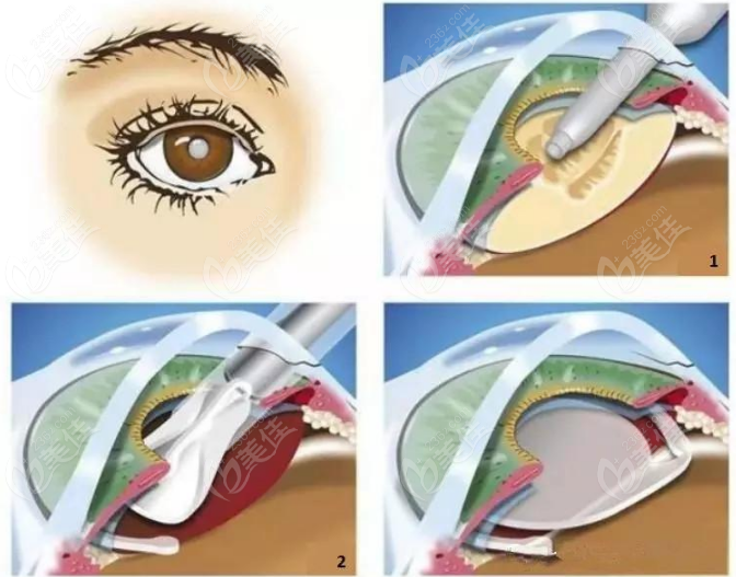 贵州晶朗眼科做晶体植入手术过程