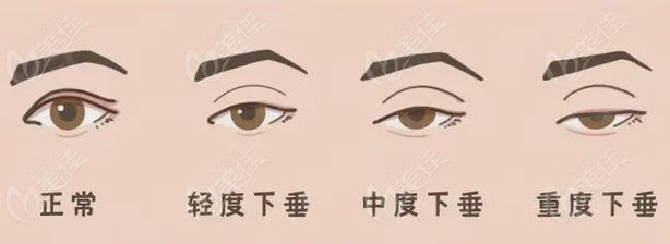 林靖雙眼皮修復(fù)失敗真的好