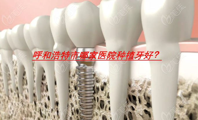 呼和浩特市哪家医院种植牙好