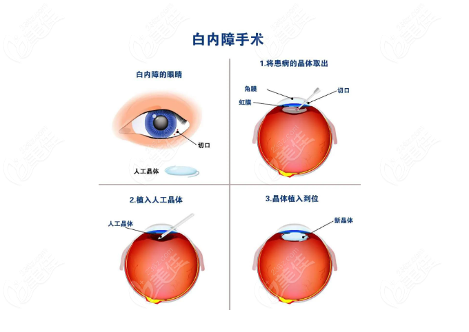 白内障手术步骤