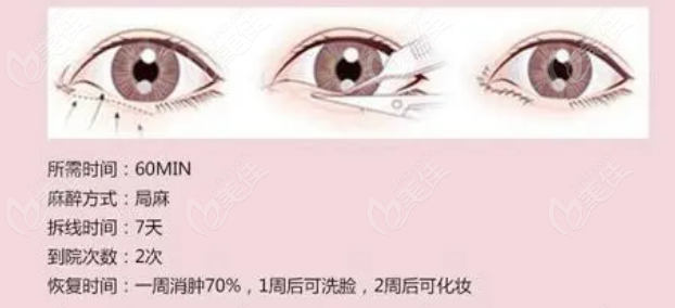 甘泉涌醫(yī)生做玖度媚眼綜合手術(shù)過程