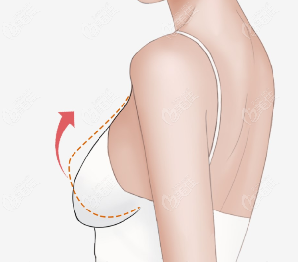 胸下垂怎么能提上去 胸下垂怎么能提上去
