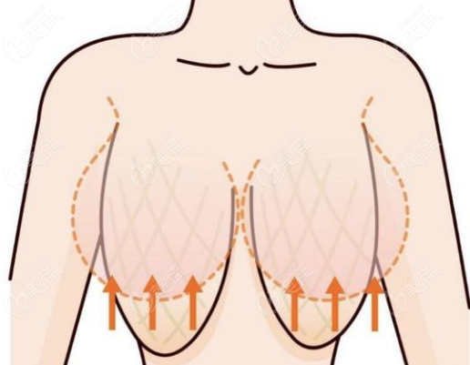 胸下垂松弛手術(shù)多少錢(qián) 胸下垂松弛手術(shù)多少錢(qián)