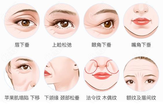 韩国普罗菲耳整形医院朴明旭做埋线面部提升能保持5年左右