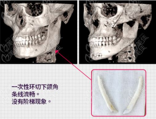 长曲线下颌角截骨图示