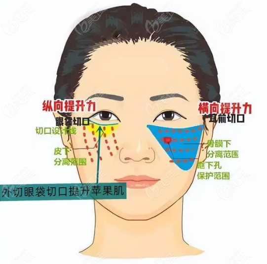 外切眼袋切口提升蘋果肌示意圖m.236z.com