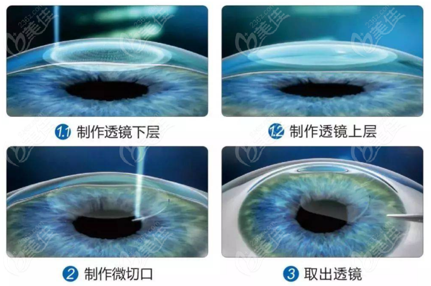 全飞秒手术示意图