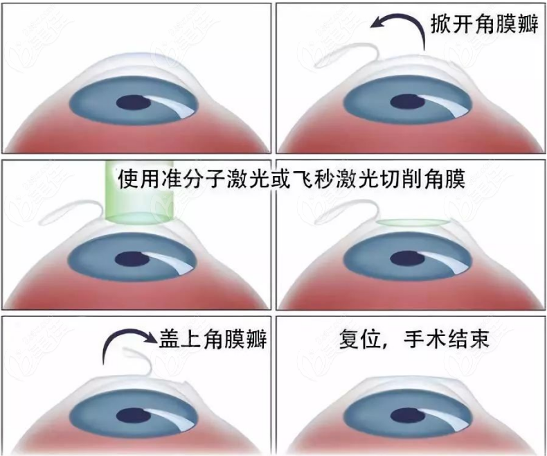 全飞秒手术示意图