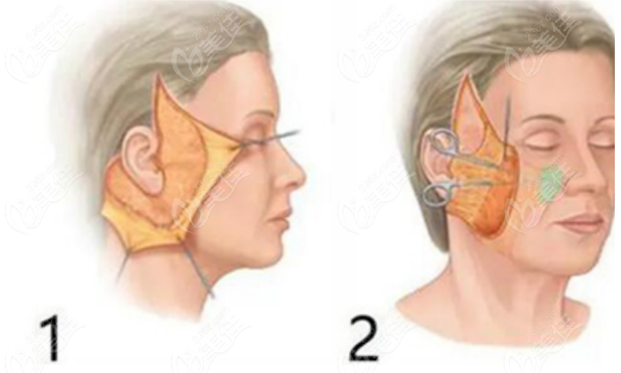 面部提升手術(shù)示意圖